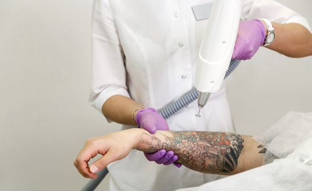 Лазерное и химическое удаление татуировок – путь к лучшему результату