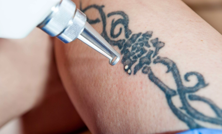 удаление тату лазером - laser tattoo removal - 25012021 - фото 3