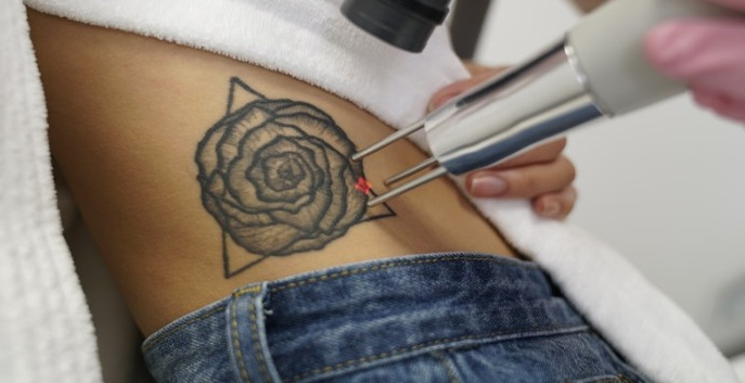 удаление тату лазером - laser tattoo removal - 25012021 - фото 6