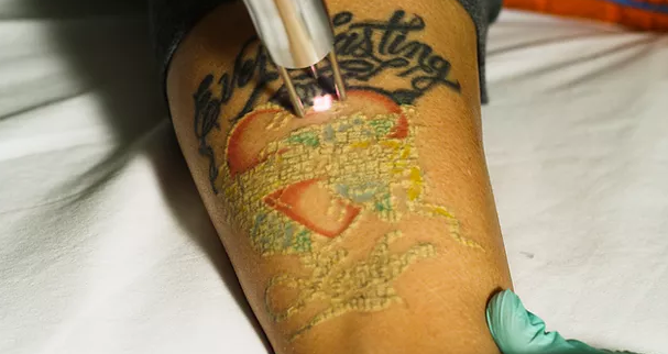 удаление тату лазером - laser tattoo removal - 25012021 - фото 7