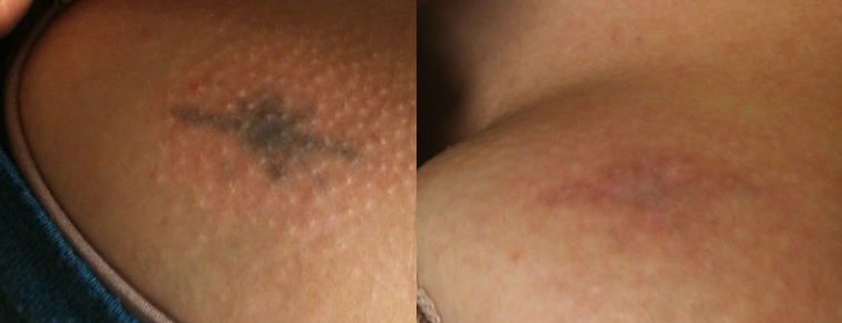 химическое удаление тату - chemical tattoo removal - 25012021 - фото 1