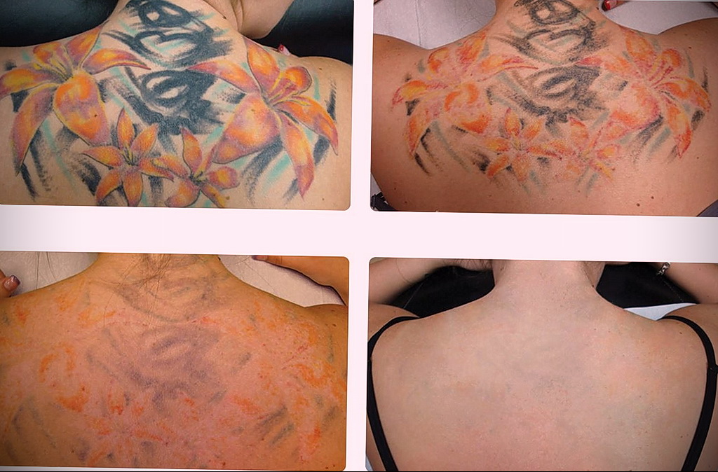Как вывести татуировку в салоне и дома - tatufoto.com 10022021 фото - 1