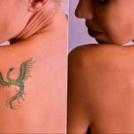 Как вывести татуировку в салоне и дома - tatufoto.com 10022021 фото - 10