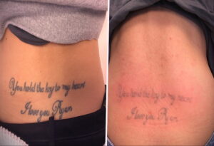 Как вывести татуировку в салоне и дома - tatufoto.com 10022021 фото - 15