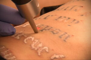 Как вывести татуировку в салоне и дома - tatufoto.com 10022021 фото - 18