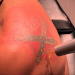 Как вывести татуировку в салоне и дома - tatufoto.com 10022021 фото - 19