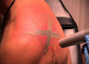 Как вывести татуировку в салоне и дома - tatufoto.com 10022021 фото - 19