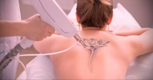 Как вывести татуировку в салоне и дома - tatufoto.com 10022021 фото - 8