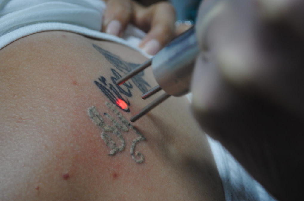 Можно сделать лазерную эпиляцию на татуировке - фото для статьи 20062021 3
