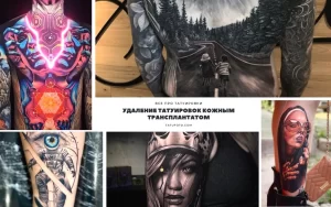 Удаление татуировок кожным трансплантатом - информация про особенности и фото примеры 29112021