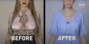 Фотография до и после удаления татуировок с груди и рук девушки. Демонстрация результатов процедуры удаления тату.