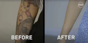 Фотография демонстрирует процесс удаления татуировки с руки. Сравнение состояния кожи до и после процедуры удаления тату.