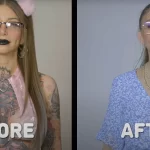 Фотография до и после удаления татуировок с рук и груди девушки. Демонстрация эффективности процедуры удаления тату.