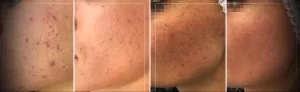 Лазерная шлифовка рубцов на лице - картинка для статьи tatufoto.com 2
