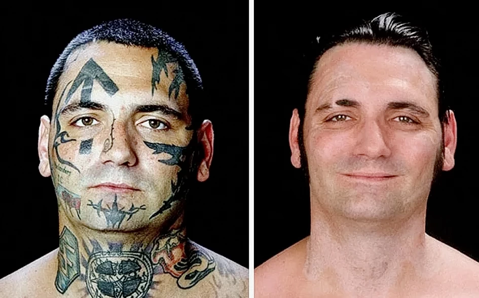 История методов удаления татуировок 1 - 200824 tatufoto.com 01