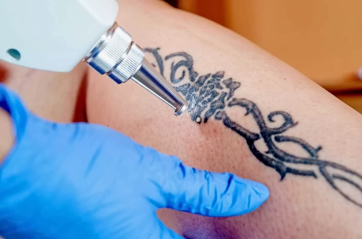 Как удалить татуировку 2 - 200824 tatufoto.com 06