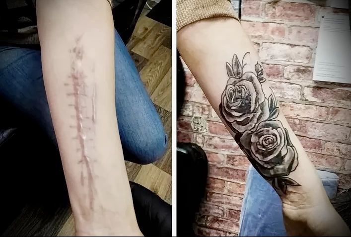 Можно ли сделать татуировку на рубце 18 - 230824 tatufoto.com 18