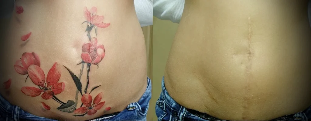 Можно ли сделать татуировку на рубце 24 - 230824 tatufoto.com 24