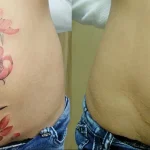 Можно ли сделать татуировку на рубце 24 - 230824 tatufoto.com 24
