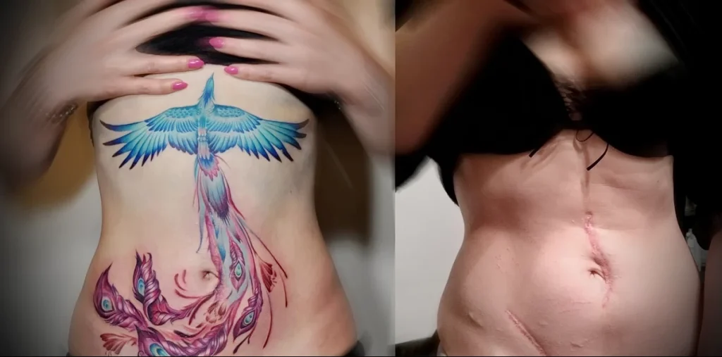Можно ли сделать татуировку на рубце 25 - 230824 tatufoto.com 25
