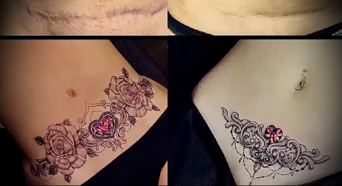 Можно ли сделать татуировку на рубце 27 - 230824 tatufoto.com 27
