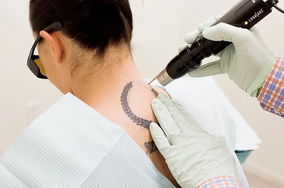 Процедуры после удаления татуировки 3 - 200824 tatufoto.com 10