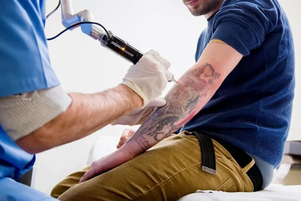 Современные методы удаления татуировок 1 - 200824 tatufoto.com 13