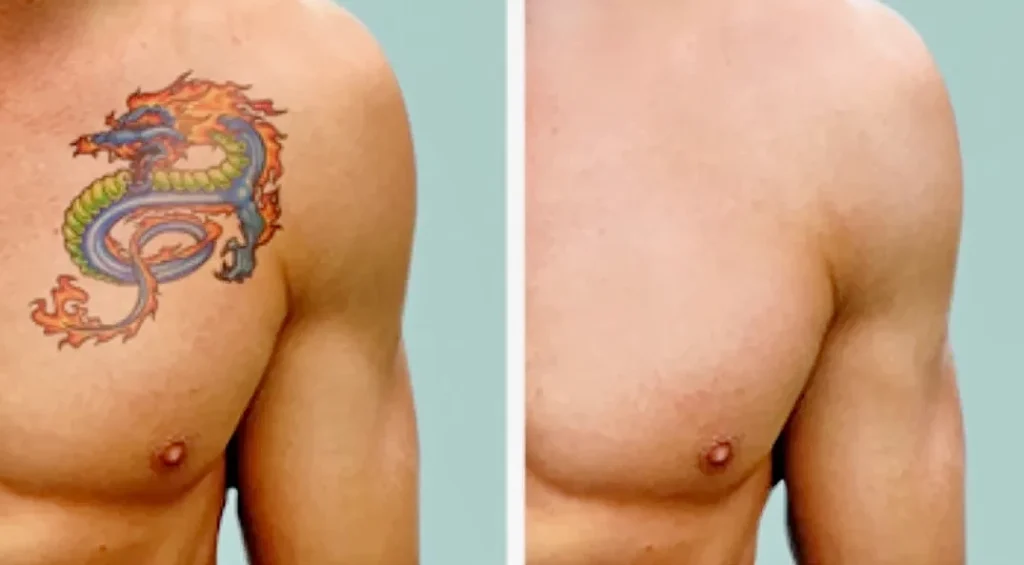 Современные методы удаления татуировок 2 - 200824 tatufoto.com 14