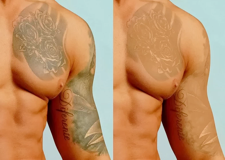 Что влияет на успешность удаления татуировки 1 - 200824 tatufoto.com 15