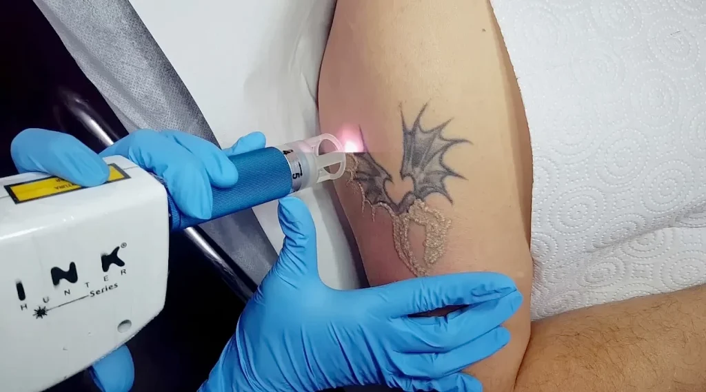 Что влияет на успешность удаления татуировки 2 - 200824 tatufoto.com 16