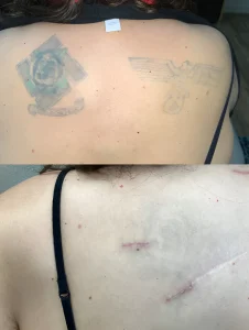 Фотография спины до и после удаления татуировки с нацистской символикой.