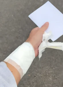 Рука Гарри перевязана после лазерного удаления татуировки