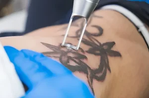 Процесс удаления татуировки лазером на коже
