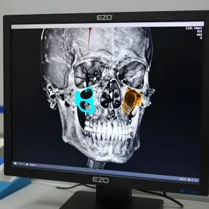 Медицинский монитор EZO с изображением 3D-реконструкции черепа в корональной проекции: видны глазницы, носовая полость, зубные ряды и импланты, а также бирюзовая и оранжевая выделенные зоны в области верхнечелюстных пазух для хирургического