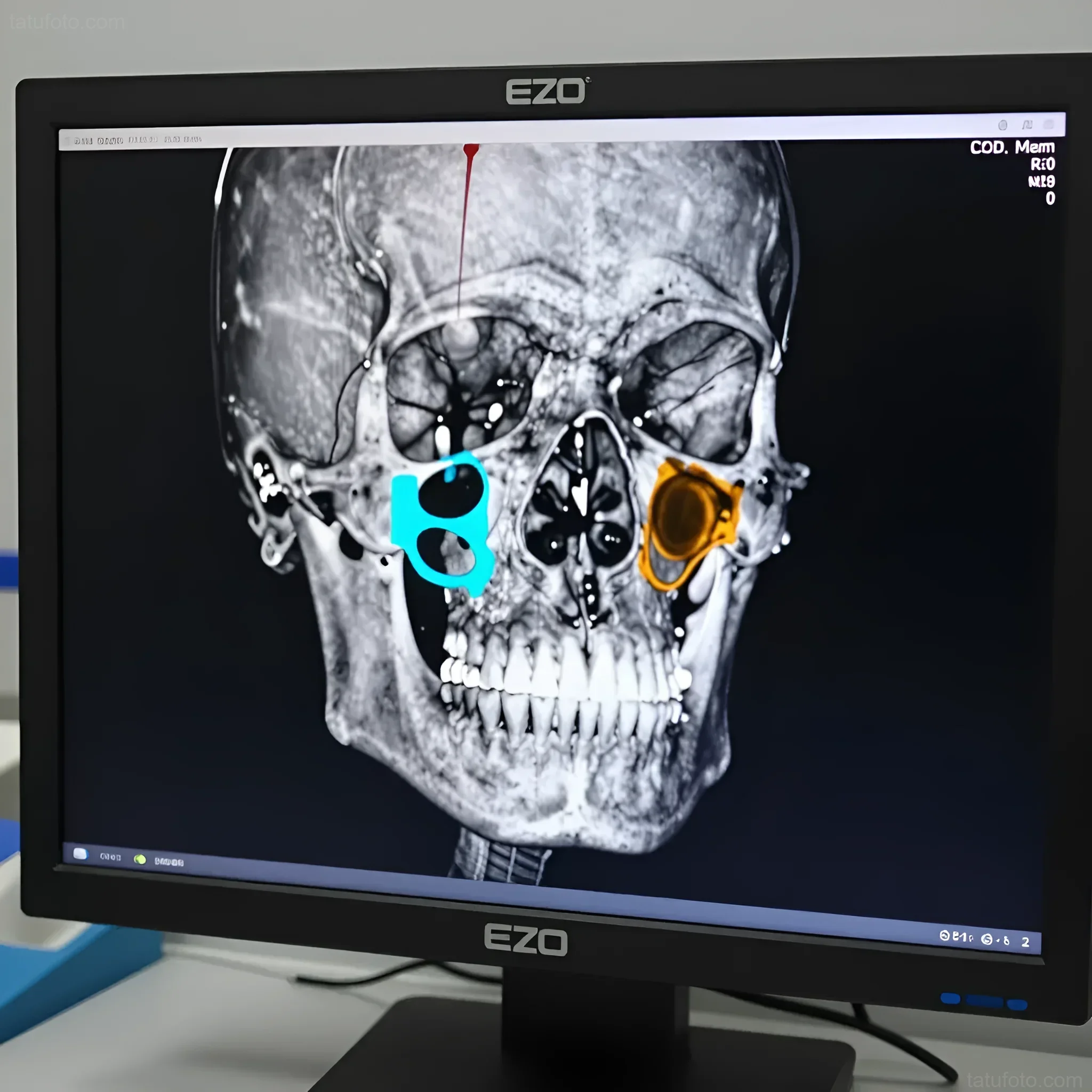 3D-реконструкция черепа на медицинском мониторе EZO: корональный срез КТ с выделенными зонами для ортогнатического планирования 29.09.2026 20:15:51
