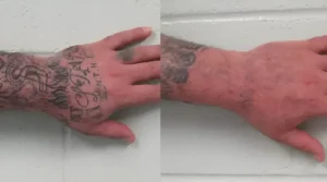 Сравнительное фото до и после лазерного удаления татуировки: слева плотный blackwork-рисунок с надписями на кисти и предплечье, справа та же рука с практически полностью стёртым изображением.